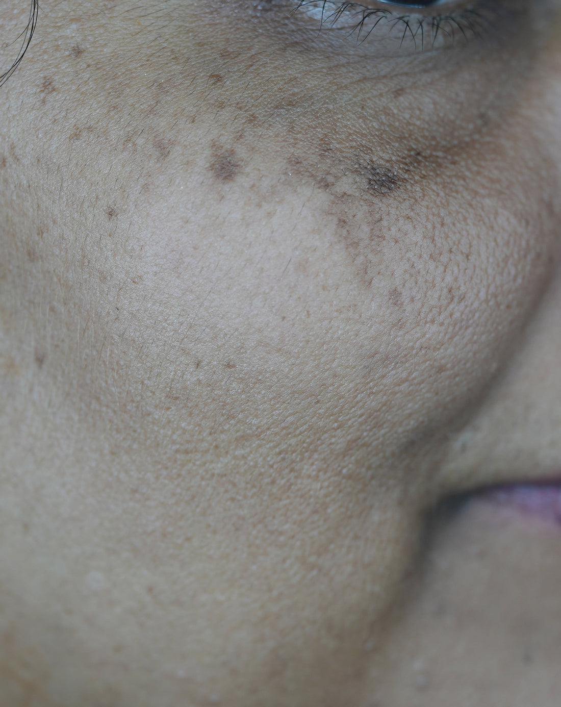 SunSpots Vs Freckles Vs Melasma: What's the Difference?