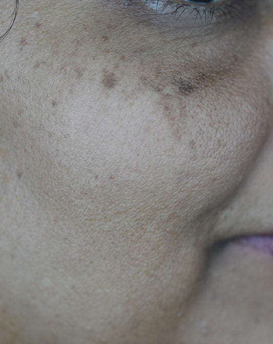 SunSpots Vs Freckles Vs Melasma: What's the Difference?