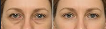 Undereye Treatments for Hollowing and Dark Circles